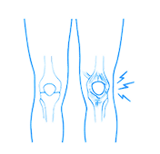 Knee pain