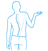 Postural asymmetry